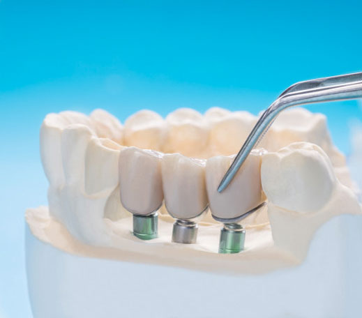 dental brdiges in san diego