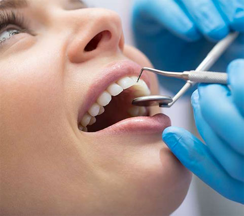 dental bonding in san diego near mira mesa