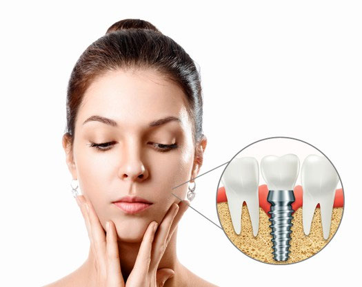 denal implants in mira mesa