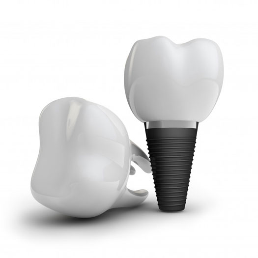 dental implants near you