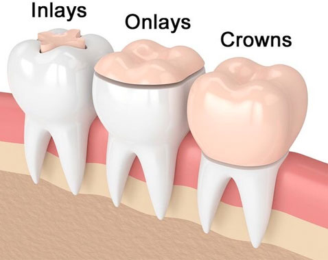 inlays and onlays in san diego near mira mesa