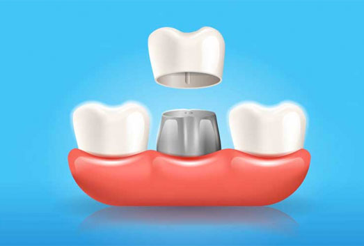 Dental Crowns In Mira Mesa