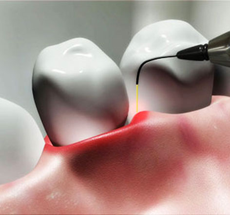 Laser Dentistry In Mira Mesa