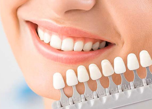 Porcelain Veneers In Mira Mesa