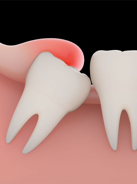 Wisodm Tooth Extraction In Mira Mesa