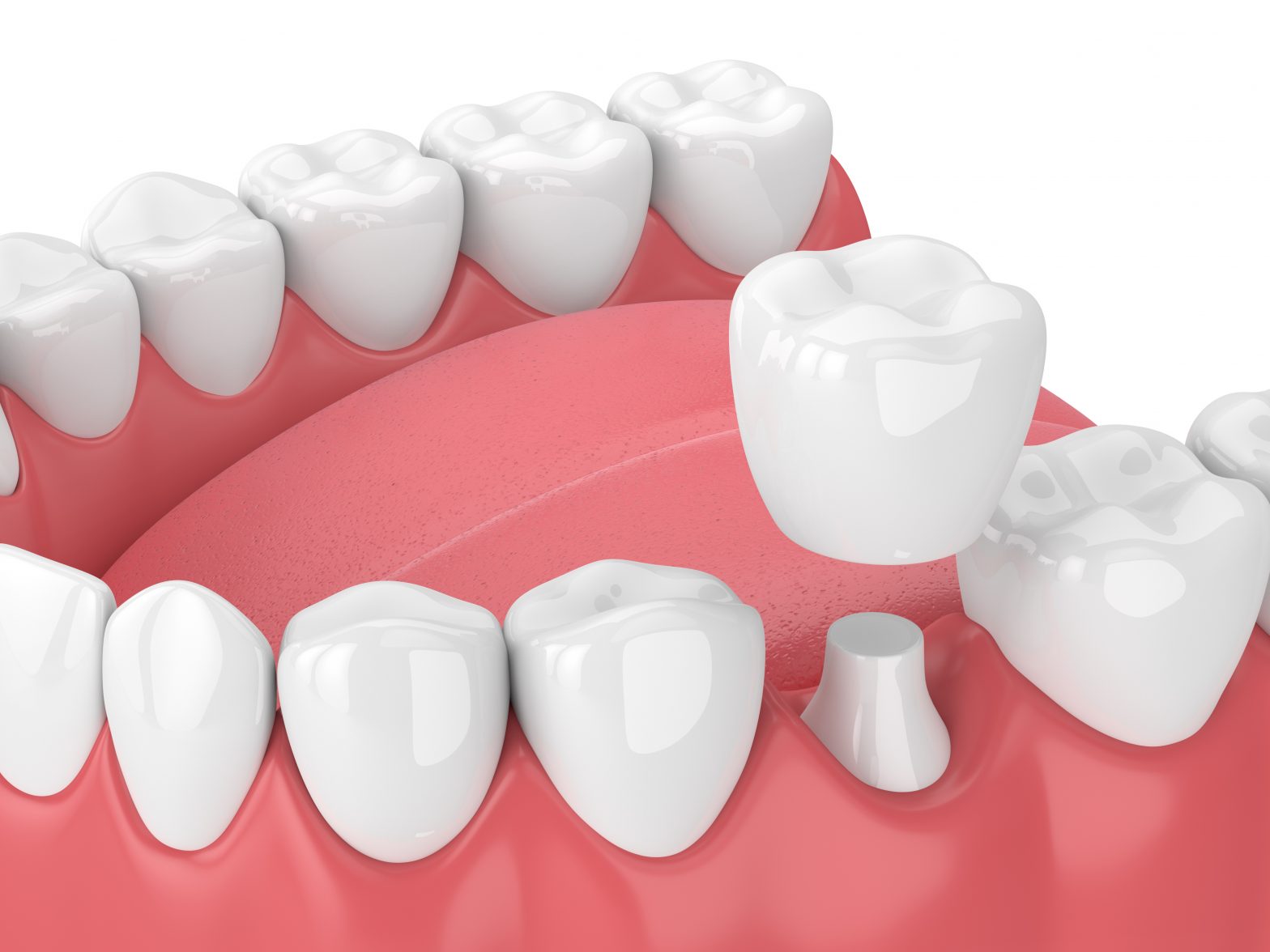 Types of Dental Crowns